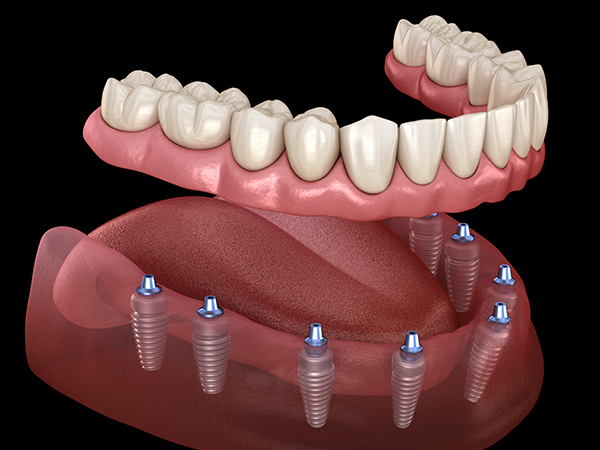 Cosmetic Dentures