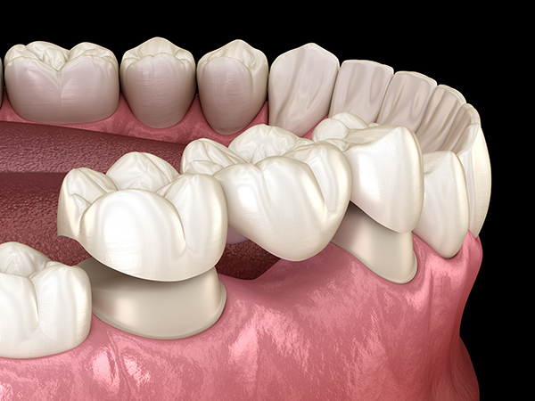 Dental Bridges