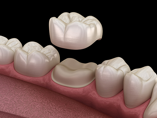 Dental Crowns