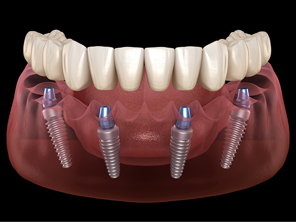 Same Day Implants